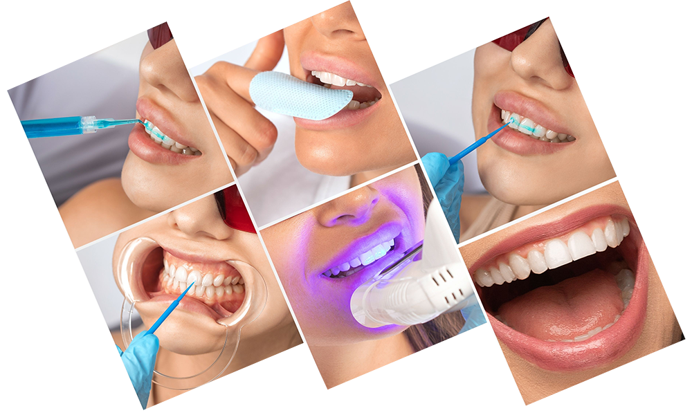 teeth whitening steps at Aria