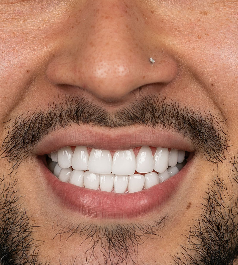 composite smile design after
