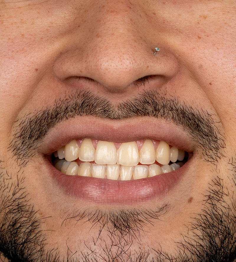 composite smile design before