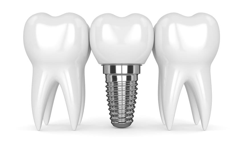 Single tooth implants