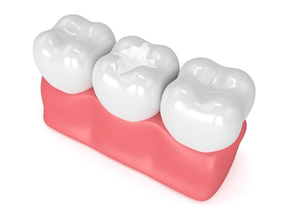 composite resin illustration