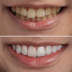 smile design before and after patient 8
