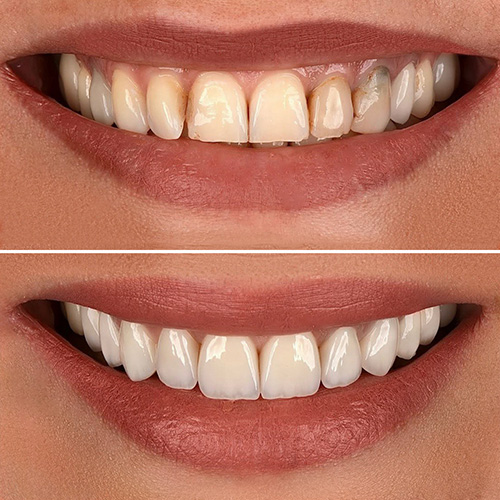 smile design before and after patient 7