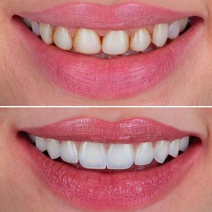 smile design before and after patient 6