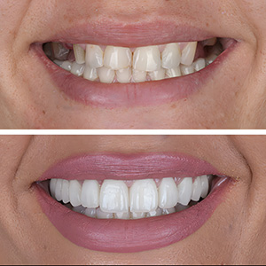 Smile Design Caso #1