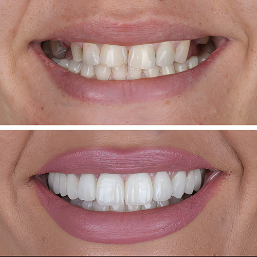 smile design before and after patient 1