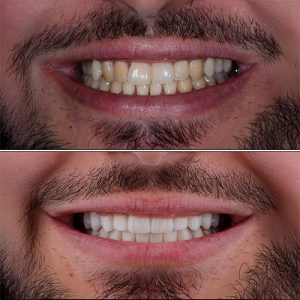 smile design before and after patient12