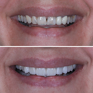 Smile Design Caso #2