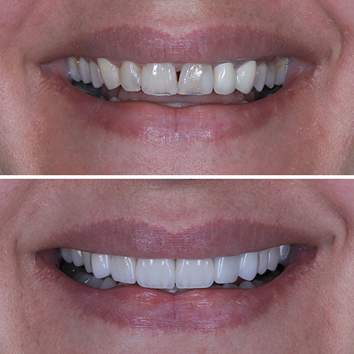 smile design before and after patient 2