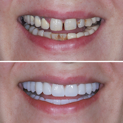 smile design before and after patient 3