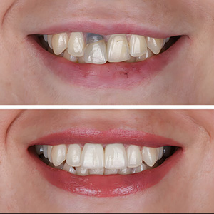 Smile Design Caso #4