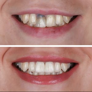 smile design before and after patient 4