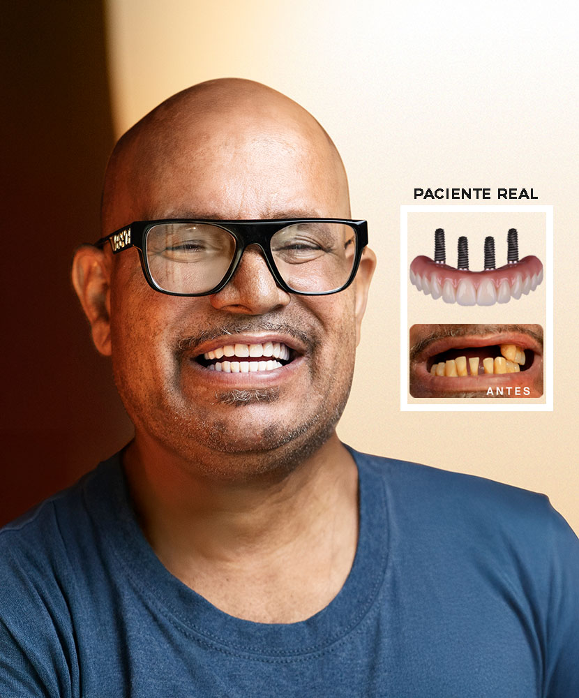 Implantes dentales All-on-4 en Miami