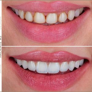 Paciente #3 Paciente #3