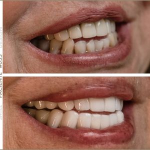 paciente smile design maribel mirrano
