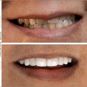 paciente smile design melanni mercado