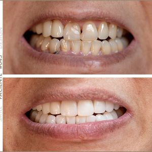 paciente smile design sandra sapon front