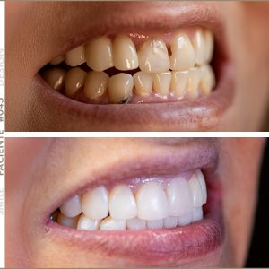 paciente smile design sandra sapon