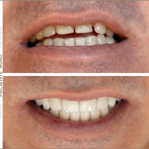 paciente smile design yosviel blanco